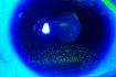 Oko – drobné eroze po obarvení fluoresceinem