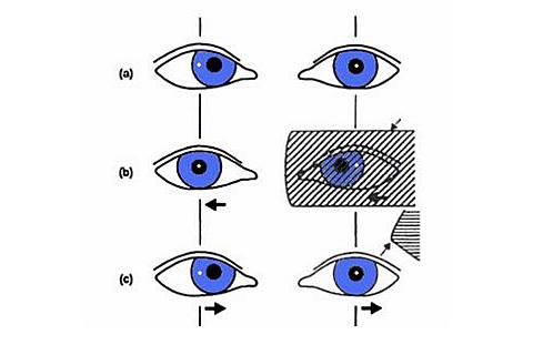 Zakrývací zkouška u pravé esotropie (pohyb oka a zakrývací destičky je naznačen pomocí šipek): (a) uchýlené pravé oko dovnitř; (b) levé oko je zakryto – obě oči se pohybují směrem doprava; (c) zakryté levé oko se uchyluje dovnitř a odkryté pravé oko přebí