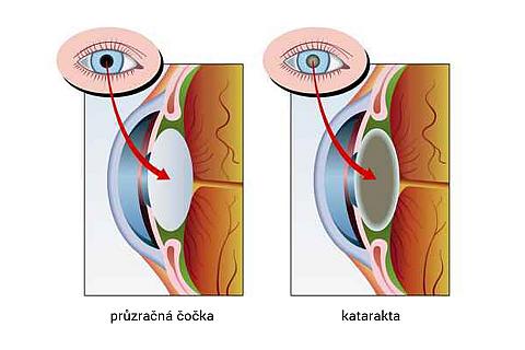 Katarakta je ztráta průhlednosti oční čočky