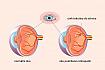 Diabetická retinopatie je onemocnění oční sítnice u diabetu mellitu
