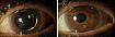 IO druhé generace v oku s maximální mydriázou, vpravo oko po třech měsících od operace [1].